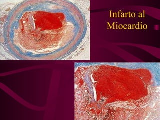Infarto al Miocardio 