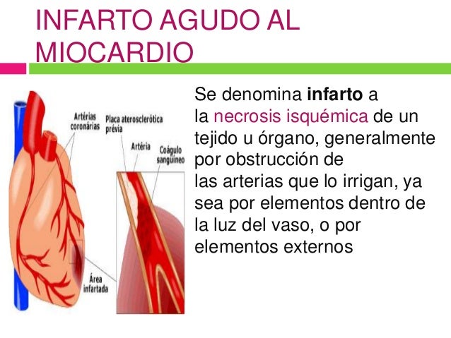 Diagnostico Nanda Para Infarto Agudo Al Miocardio es.slideshare.net