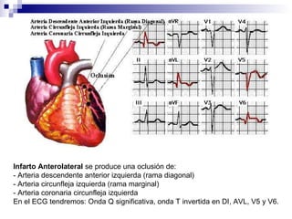 Infarto Anterolateral  se produce una oclusión de: - Arteria descendente anterior izquierda (rama diagonal) - Arteria circunfleja izquierda (rama marginal) - Arteria coronaria circunfleja izquierda En el ECG tendremos: Onda Q significativa, onda T invertida en DI, AVL, V5 y V6. 