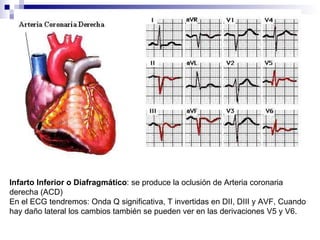 Infarto Inferior o Diafragmático : se produce la oclusión de Arteria coronaria derecha (ACD) En el ECG tendremos: Onda Q significativa, T invertidas en DII, DIII y AVF, Cuando hay daño lateral los cambios también se pueden ver en las derivaciones V5 y V6. 