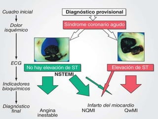 Infarto agudo del miocardio con elevacion del segmento | PPTX