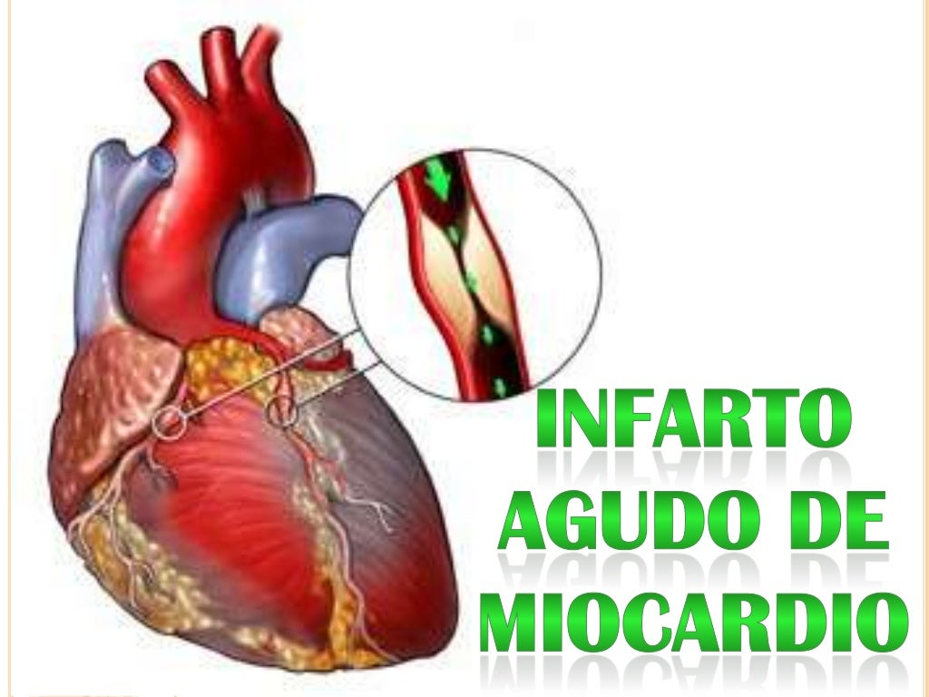 Infarto Agudo Del Miocardio