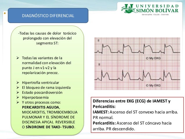Infarto agudo de miocardio con elevacion del segmento
