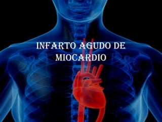 Infarto agudo de
    MIocardIo
 