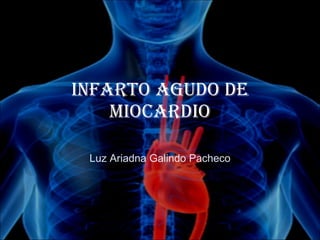 Infarto Agudo de Miocardio Luz Ariadna Galindo Pacheco 