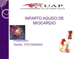 JULIACA
INFARTO AGUDO DE
MIOCARDIO

Presentado:
Yaneth, TITO MAMANI

 