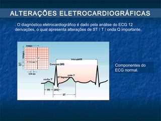 ALTERAÇÕES ELETROCARDIOGRÁFICAS
. O diagnóstico eletrocardiográfico é dado pela análise do ECG 12
derivações, o qual apresenta alterações de ST / T / onda Q importante.
Componentes do
ECG normal.
 