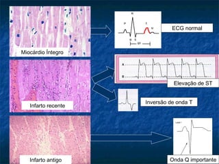 Miocárdio Íntegro
Infarto recente
Infarto antigo
ECG normal
Elevação de ST
Onda Q importante
Inversão de onda T
 