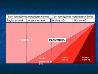 Sem liberação de marcadores séricos Com liberação de marcadores séricos
Angina estável Angina Instável IAM sem Q IAM com Q
PENUMBRA
Infarto
Não Q
Infarto
Com Q
Lesão
(Elevação de
ST)
ISQUEMIA
 