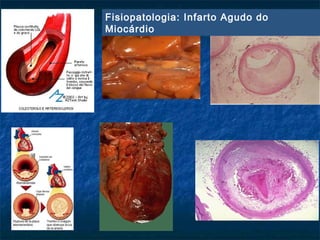 Fisiopatologia: Infarto Agudo do
Miocárdio
 