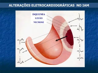 ISQUEMIA LESÃO NECROSE ALTERAÇÕES ELETROCARDIOGRÁFICAS  NO IAM 