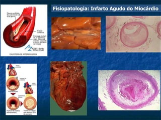 Fisiopatologia: Infarto Agudo do Miocárdio 