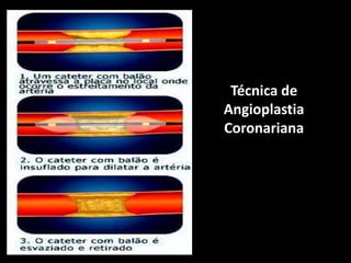 Técnica de
Angioplastia
Coronariana
 