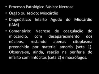 • Processo Patológico Básico: Necrose
• Órgão ou Tecido: Miocárdio
• Diagnóstico: Infarto Agudo do Miocárdio
(IAM)
• Comentário: Necrose de coagulação do
miocárdio, com desaparecimento dos
núcleos, restando apenas citoplasma
preenchido por material amorfo (seta 1).
Observa-se, ainda, reação na periferia do
infarto com linfócitos (seta 2) e macrófagos.
 