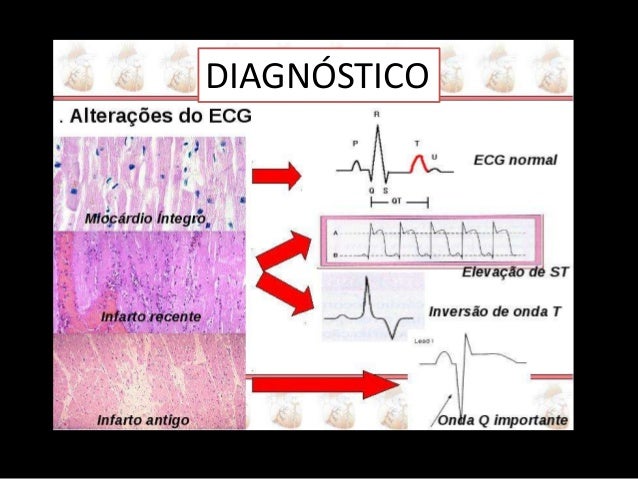 Diagnostico Nanda Para Infarto Agudo Al Miocardio pt.slideshare.net