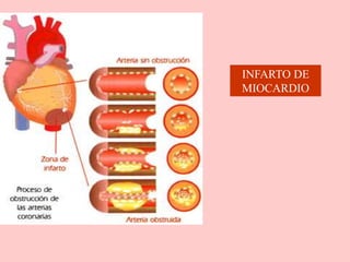 INFARTO DE
MIOCARDIO
 