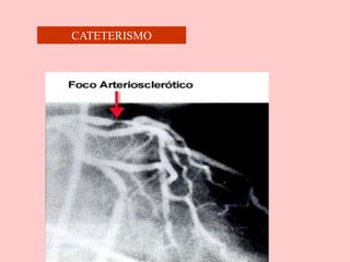 CATETERISMO
 