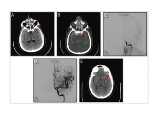Comprehensive Overview of Cerebral Infarction: Classification ...