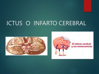 ICTUS O INFARTO CEREBRAL
 