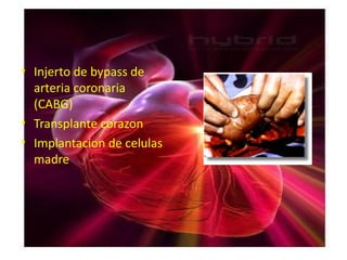 • Injerto de bypass de
  arteria coronaria
  (CABG)
• Transplante corazon
• Implantacion de celulas
  madre
 