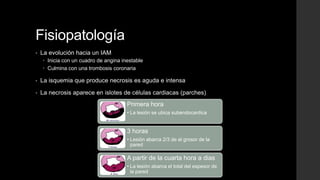 Fisiopatología
• La evolución hacia un IAM
 Inicia con un cuadro de angina inestable
 Culmina con una trombosis coronaria
• La isquemia que produce necrosis es aguda e intensa
• La necrosis aparece en islotes de células cardiacas (parches)
Primera hora
• La lesión se ubica subendocardica
3 horas
• Lesión abarca 2/3 de el grosor de la
pared
A partir de la cuarta hora a dias
• La lesión abarca el total del espesor de
la pared
 