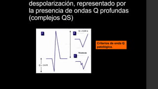 despolarización, representado por
la presencia de ondas Q profundas
(complejos QS)
Criterios de onda Q
patológica.
 