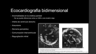 Ecocardiografia bidimensional
• Anormalidades en la cinética parietal
 No se puede diferenciar entre un IAM o una cicatriz vieja
• Infarto de ventrículo derecho
• Aneurisma
• Derrame pericárdico
• Comunicación interventricular
• Regurgitación mitral
 
