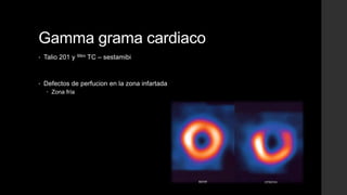 Gamma grama cardiaco
• Talio 201 y 99m TC – sestamibi
• Defectos de perfucion en la zona infartada
 Zona fría
 