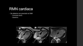 RMN cardiaca
• Se detecta con precisión el IAM
 Contraste tardío
 Gadolinio
 