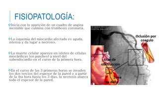 FISIOPATOLOGÍA: 
Inicia con la aparición de un cuadro de angina 
inestable que culmina con trombosis coronaria. 
La isquemia del miocardio afectado es aguda, 
intensa y da lugar a necrosis. 
La muerte celular aparece en islotes de células 
miocárdicas (en parches) a nivel del 
subendocardio en el curso de la primera hora. 
En el curso de las 3 primeras horas se invaden 
los dos tercios del espesor de la pared y a partir 
de la 4ta hora hasta los 3 días, la necrosis abarca 
todo el espesor de la pared. 
 