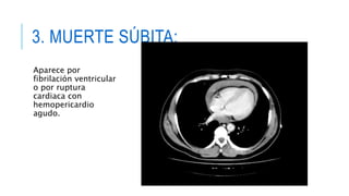 3. MUERTE SÚBITA: 
Aparece por 
fibrilación ventricular 
o por ruptura 
cardiaca con 
hemopericardio 
agudo. 
 
