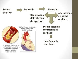 Trombo
oclusivo
Isquemia Necrosis
Disminución de
contractilidad
cardiaca
Insuficiencia
cardiaca
Alteraciones
del ritmo
cardiaco
Disminución
del volumen
de eyección
 