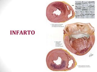 INFARTO
 