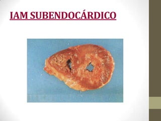 IAM SUBENDOCÁRDICO
 