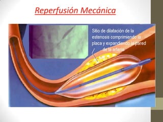 Reperfusión Mecánica
 