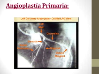 Angioplastía Primaria:
 