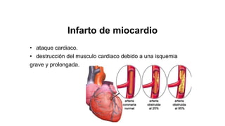 Infarto de miocardio
• ataque cardiaco.
• destrucción del musculo cardiaco debido a una isquemia
grave y prolongada.
 