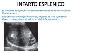 INFARTO ESPLENICO 
Es la muerte de tejido (necrosis) en el bazo debido a una obstrucción del 
flujo sanguíneo. 
Si se observa una imagen hipoecoica, en forma de cuña y periférica 
típica, el primer diagnóstico debe ser el de infarto esplénico. 
 