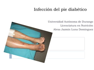 Infección del pie diabético 
Universidad Autónoma de Durango 
Licenciatura en Nutrición 
Alexa Jazmín Luna Domínguez 
 