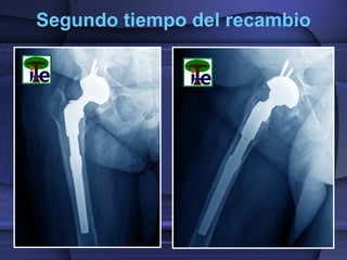 Infección de protesis total de cadera no cementada