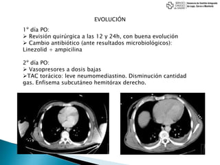 EVOLUCIÓN
1º día PO:
 Revisión quirúrgica a las 12 y 24h, con buena evolución
 Cambio antibiótico (ante resultados microbiológicos):
Linezolid + ampicilina
2º día PO:
 Vasopresores a dosis bajas
TAC torácico: leve neumomediastino. Disminución cantidad
gas. Enfisema subcutáneo hemitórax derecho.
 