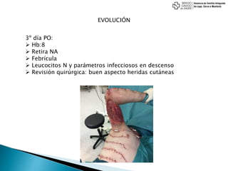 EVOLUCIÓN
3º día PO:
 Hb:8
 Retira NA
 Febrícula
 Leucocitos N y parámetros infecciosos en descenso
 Revisión quirúrgica: buen aspecto heridas cutáneas
 