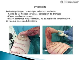 EVOLUCIÓN
Revisión quirúrgica: buen aspecto heridas cutáneas.
-Cierre de las heridas torácicas, colocación de drenajes
-Cierre heridas antebrazo.
-Brazo: extremos muy separados, no es posible la aproximación.
Se valorará necesidad de injerto.
 