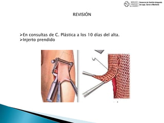 REVISIÓN
En consultas de C. Plástica a los 10 días del alta.
Injerto prendido
 