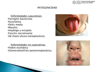 PATOGENICIDAD
Enfermedades supurativas:
•Faringitis bacteriana
•Escarlatina
•Otitis media
•Mastitis
•Impétigo y erisipela
•Fascitis necrotizante
•Sd shock tóxico estreptocócico
Enfermedades no supurativas:
•Fiebre reumática
•Glomerulonefritis postestreptocócica
 