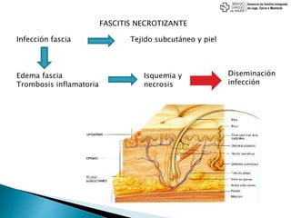 FASCITIS NECROTIZANTE
Infección fascia Tejido subcutáneo y piel
Edema fascia
Trombosis inflamatoria
Isquemia y
necrosis
Diseminación
infección
 