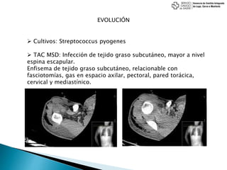 EVOLUCIÓN
 Cultivos: Streptococcus pyogenes
 TAC MSD: Infección de tejido graso subcutáneo, mayor a nivel
espina escapular.
Enfisema de tejido graso subcutáneo, relacionable con
fasciotomías, gas en espacio axilar, pectoral, pared torácica,
cervical y mediastínico.
 