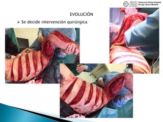 EVOLUCIÓN
 Se decide intervención quirúrgica
 