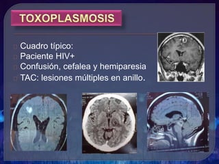 Cuadro típico:
Paciente HIV+
Confusión, cefalea y hemiparesia
TAC: lesiones múltiples en anillo.
 