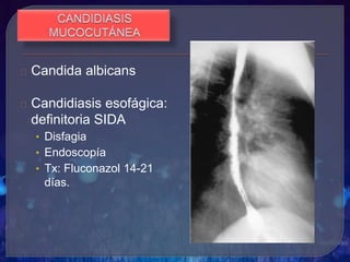 Candida albicans
Candidiasis esofágica:
definitoria SIDA
• Disfagia
• Endoscopía
• Tx: Fluconazol 14-21
días.
 